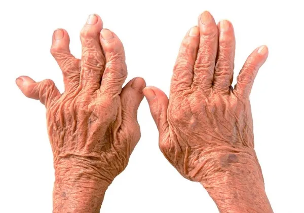 При бруцеллезе возникает артрит пальцев